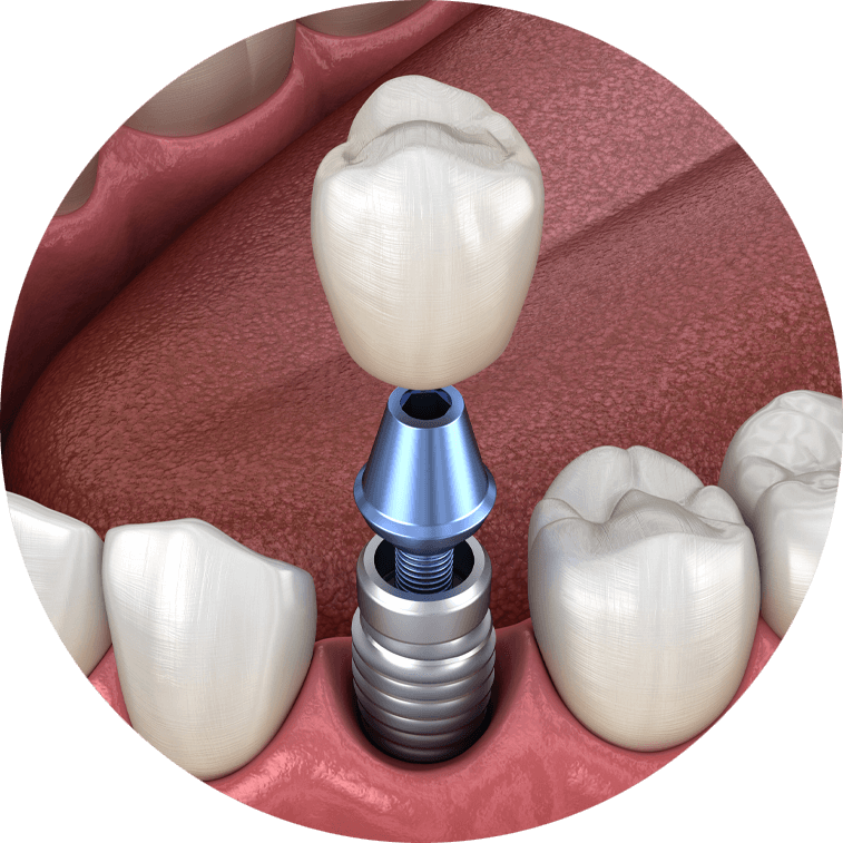 Zoomed in image of a model of a single implant, abutment, and crown.