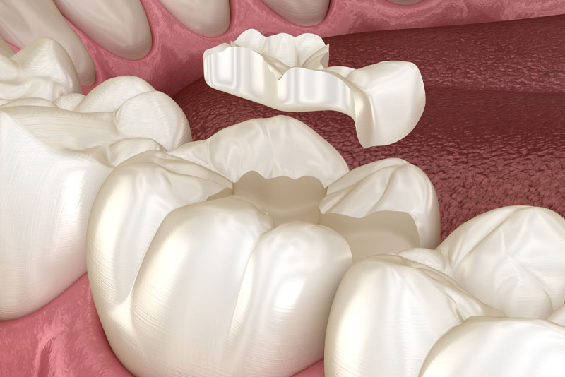 Dental inlay about to be placed on a tooth.