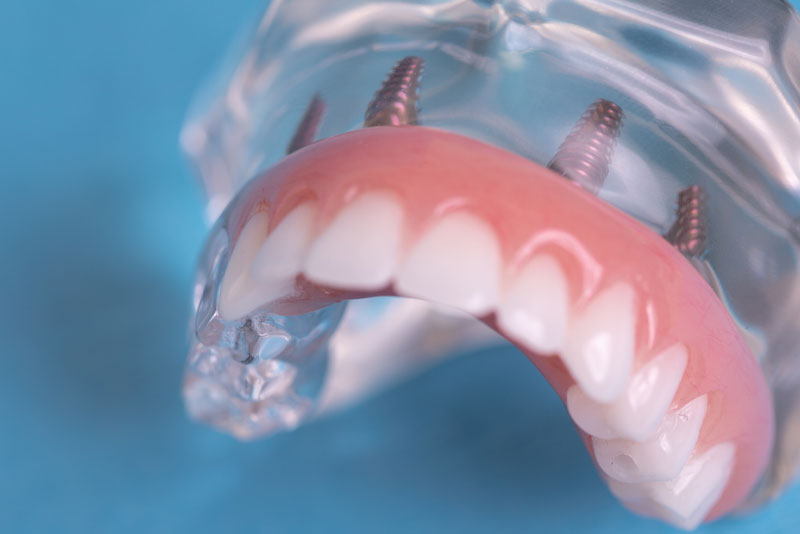 Model of as All-on-4 full upper arch dental implant prosthesis attached to a clear base.