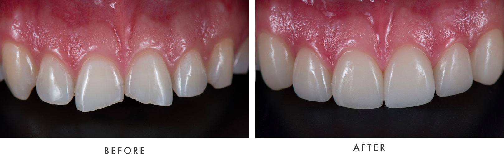 Porcelain Veneers