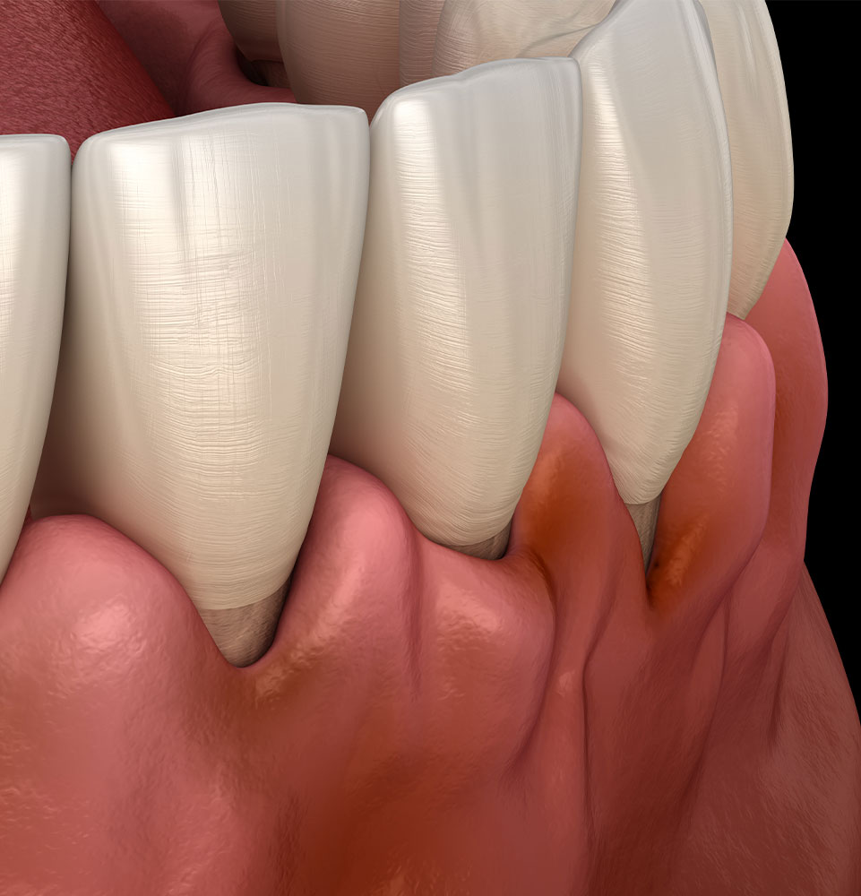 gum recession graphic