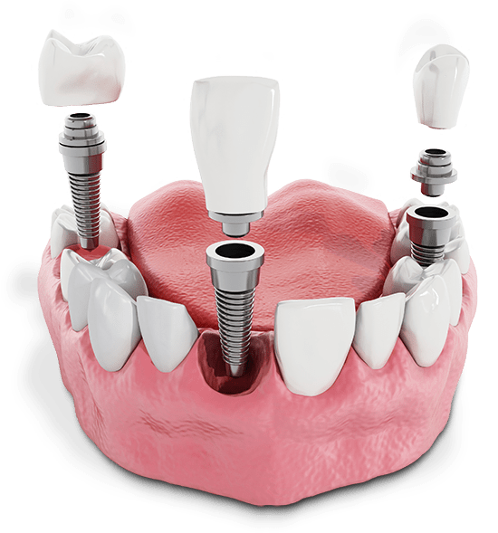 Lower jaw model with 3 dental implants, abutments, and crowns hovering above the jaw.
