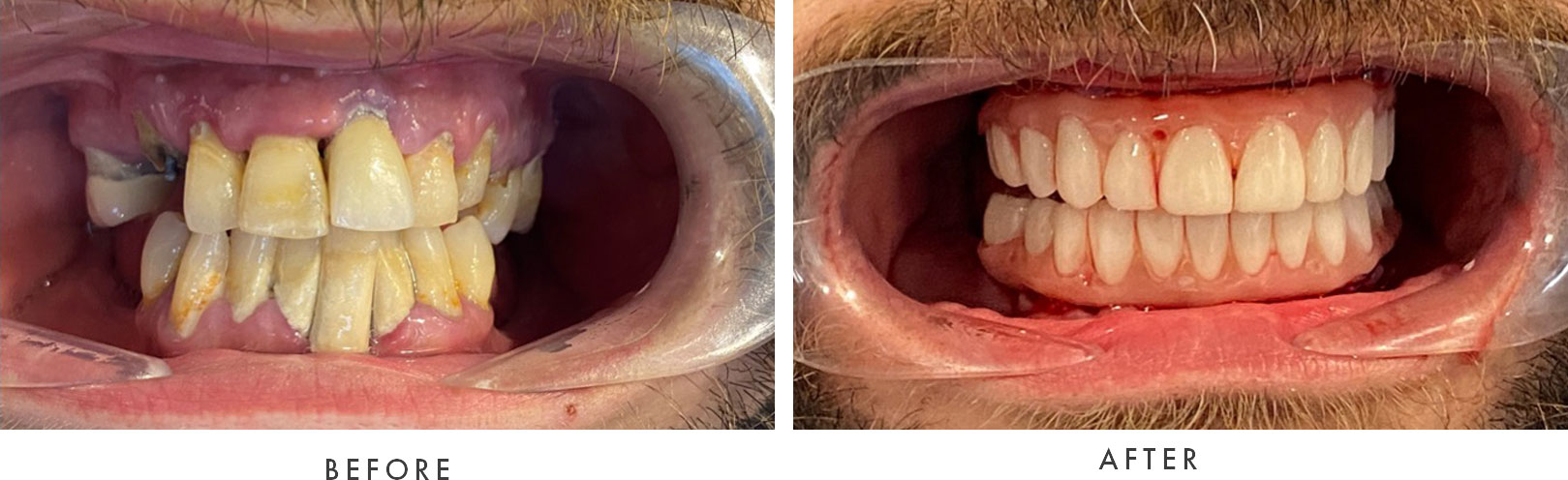 Case1 beforeandafter smilegallery