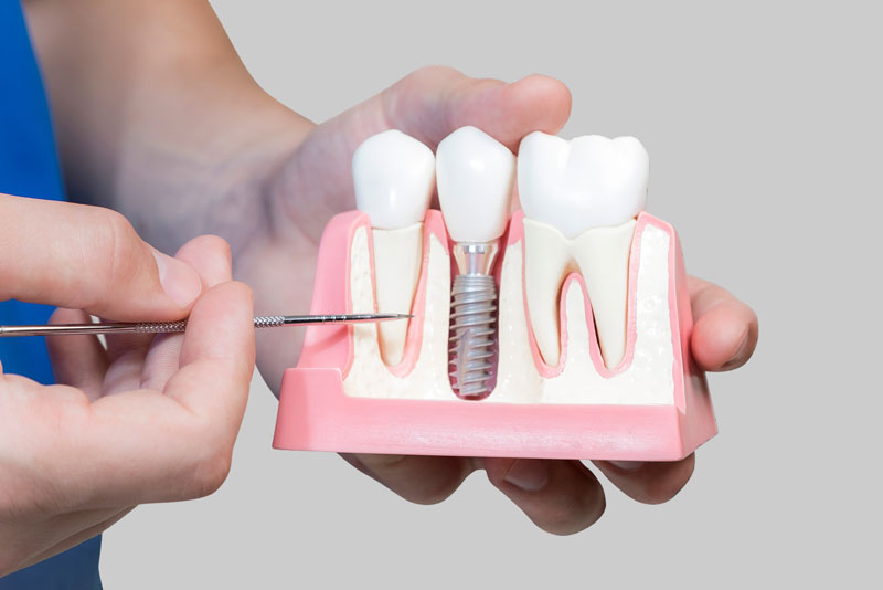 Dental Assistant Showing Off A Dental Implant In A Jawbone Cutaway Model in Scituate, MA