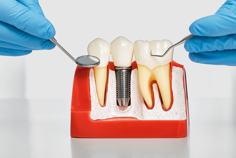 What Is Osseointegration When It Comes To Dental Implants?