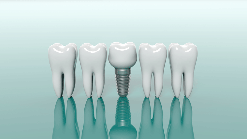 3d model of 4 teeth with a dental implant in the middle of them