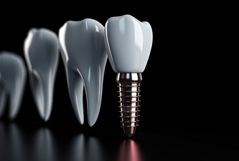 Digital model of a dental implant on a blacked out background