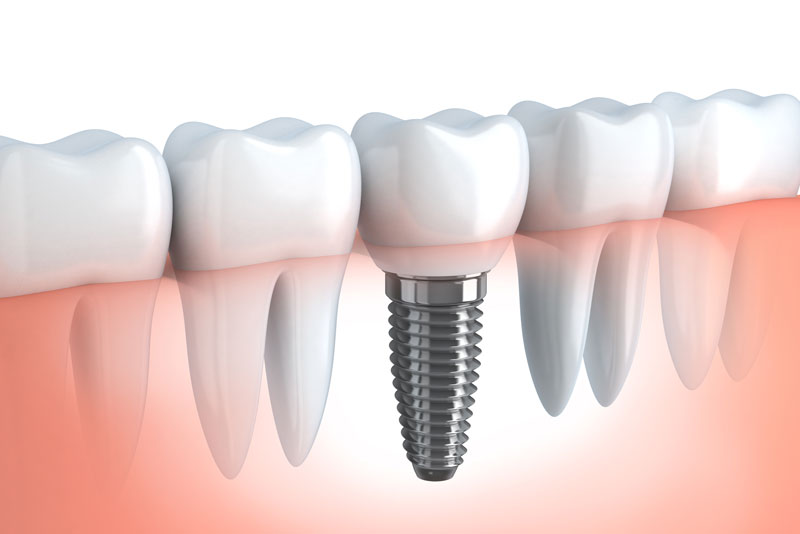 Complete Tooth Implants: Your Essential Guide to a Lasting, Confident Smile