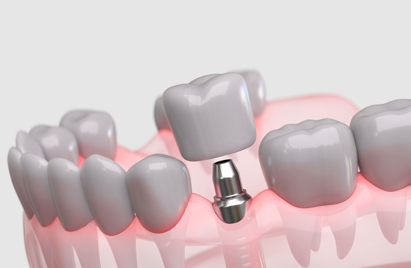 The Complete Dental Implant Process: Your Comprehensive Patient Guide