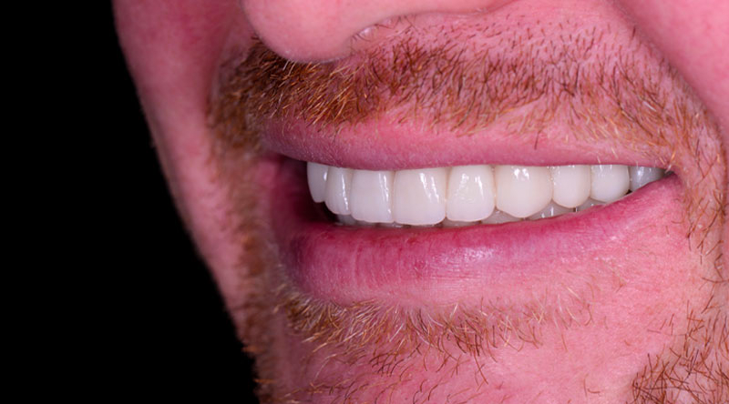 Dental Implants Case #01 After image