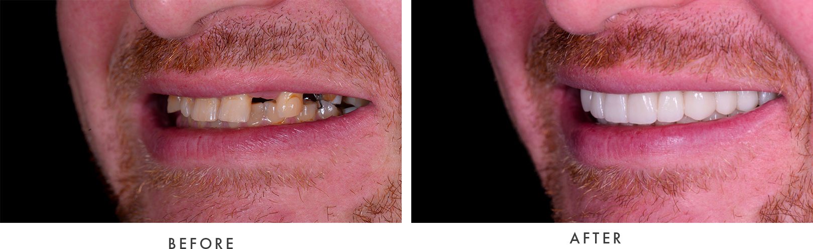 Dental Implants Case #01 Combined Image