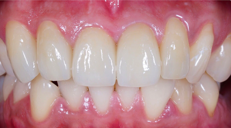 Dental Implants Case #02 After image