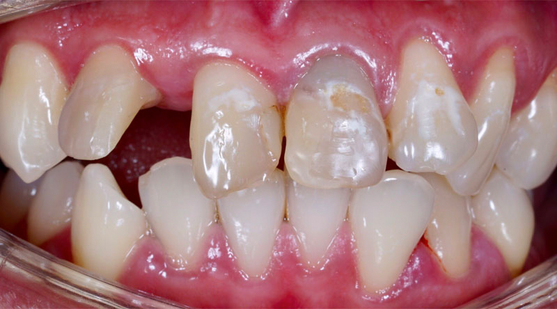 Dental Implants Case #02 Before image