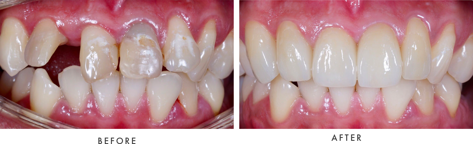 Dental Implants Case #02 Combined Image