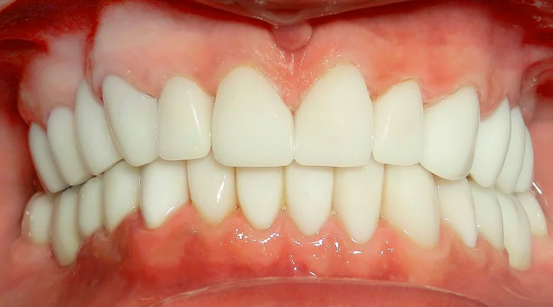 Dental Implants Case #03 After image
