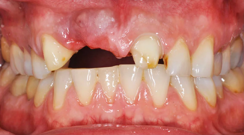 Dental Implants Case #03 Before image