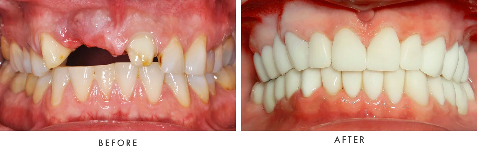 Dental Implants Case #03 Combined Image