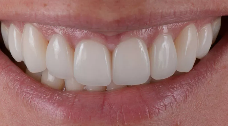Porcelain Veneers Case #01 After image
