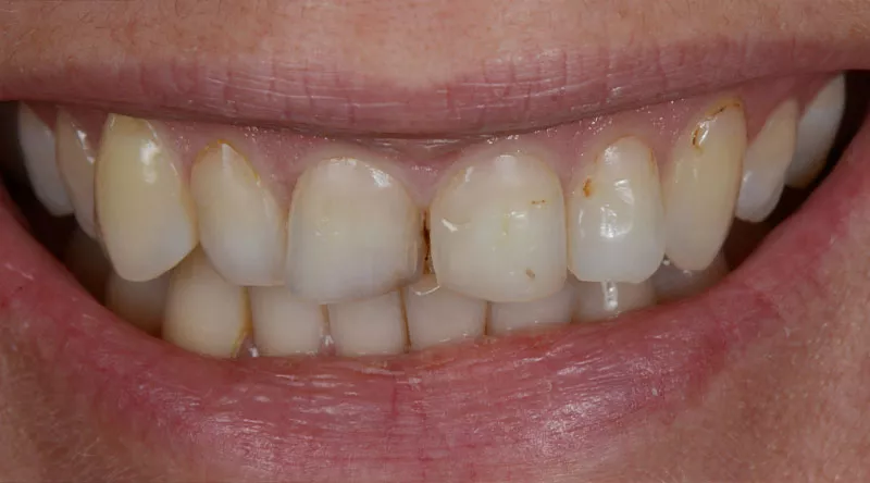 Porcelain Veneers Case #01 Before image