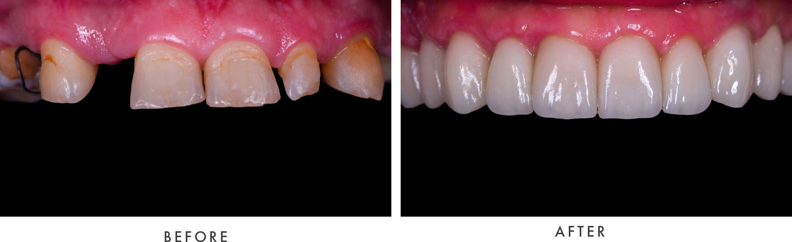 FM Dental Implants Case #01 Combined Image