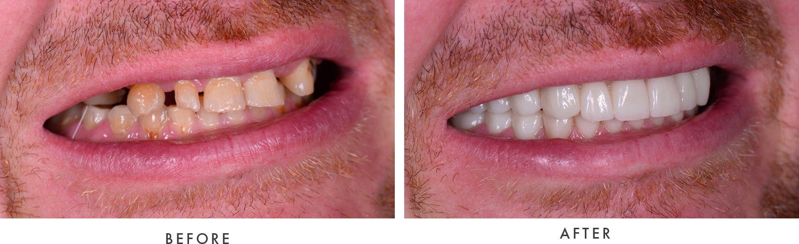 FM Dental Implants Case #02 Combined Image