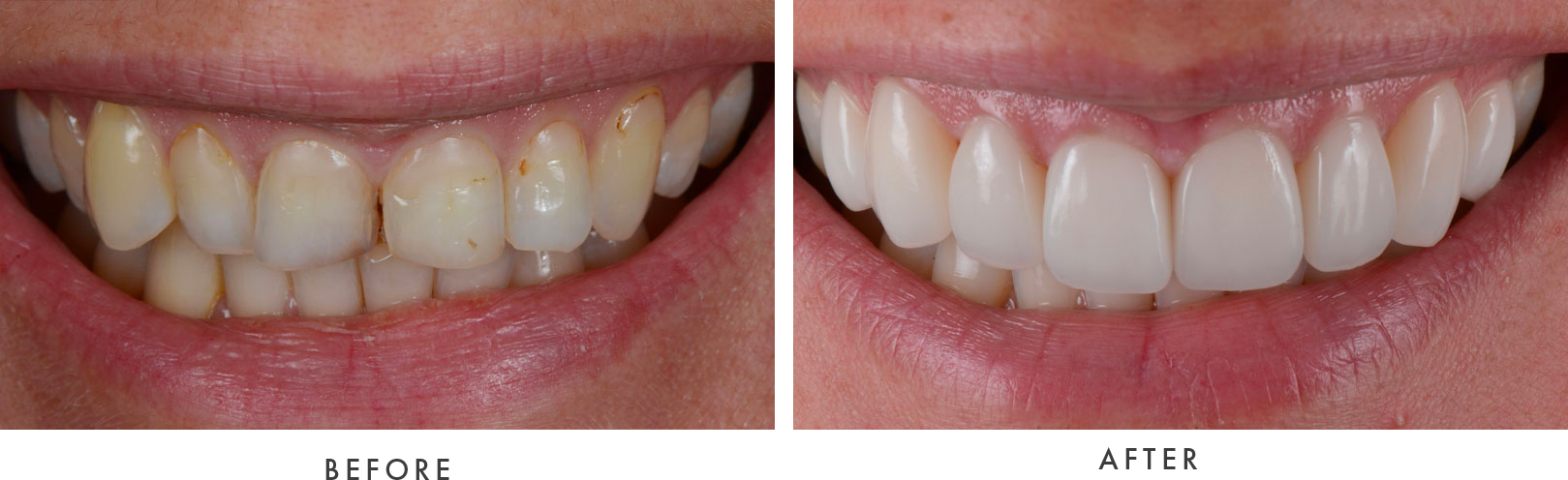 Porcelain Veneers Case #01 Combined Image