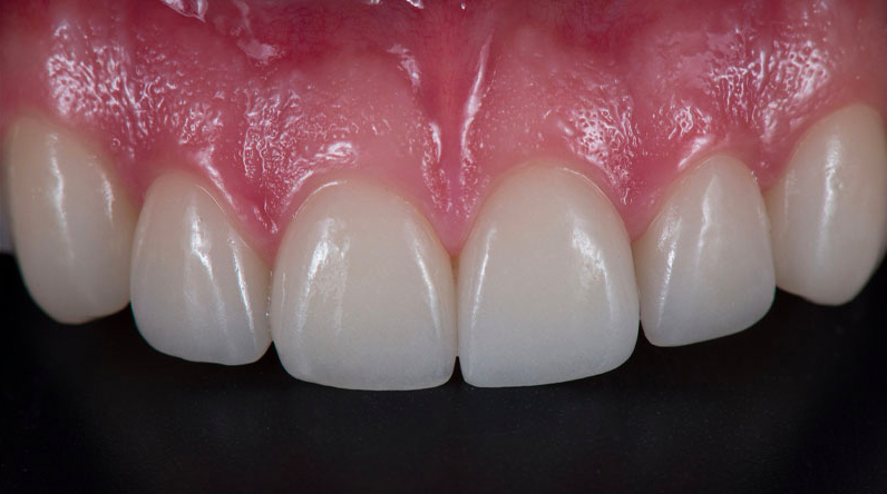 Porcelain Veneers Case #02 After image