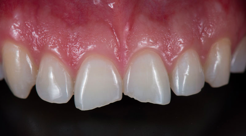 Porcelain Veneers Case #02 Before image