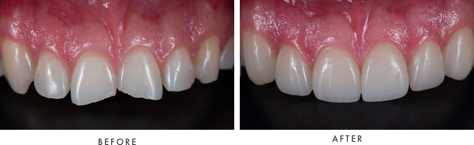 Porcelain Veneers Case #02 Combined Image