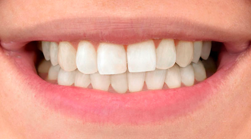 Teeth Whitening Case #01 After image