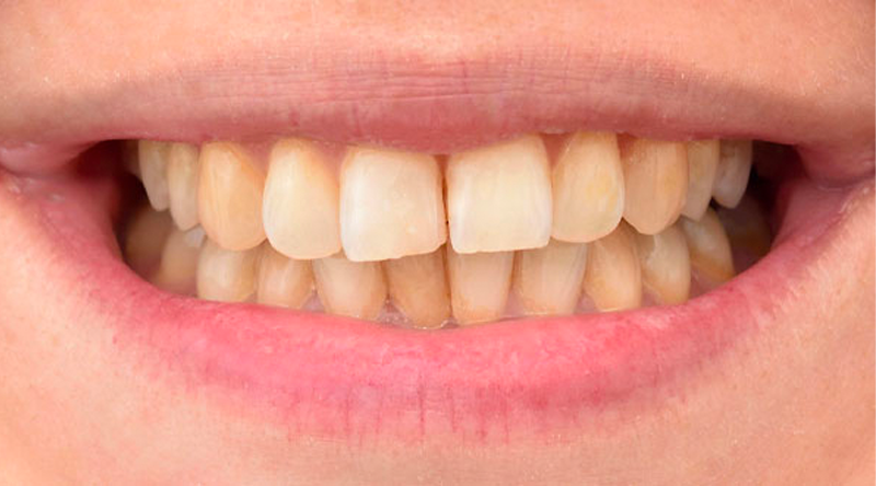 Teeth Whitening Case #01 Before image