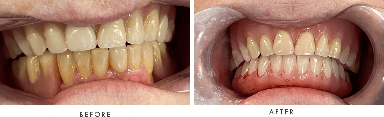 FM Dental Implants Case #04 Combined Image